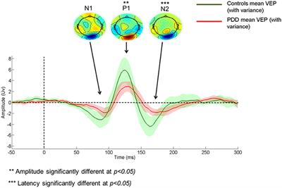 Exploring Bottom-Up Visual Processing and Visual Hallucinations in Parkinson's Disease With Dementia